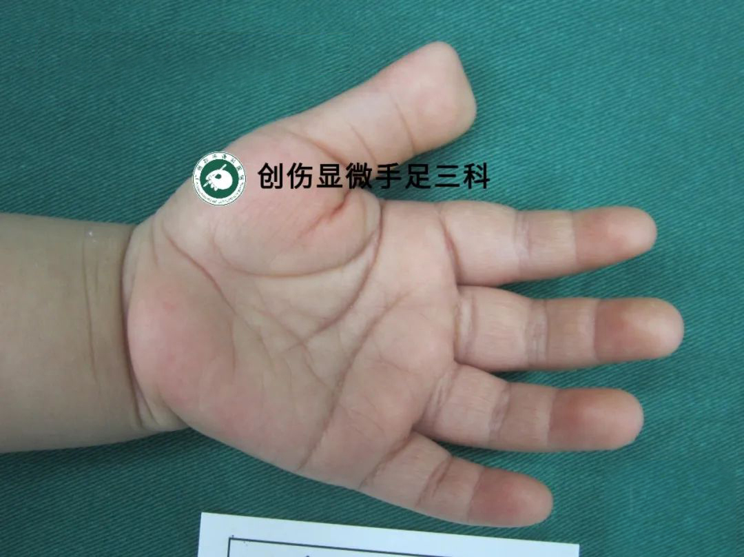 并指免植皮 | 案例10 《两根手指并成一根，术后恢复正常》-陈江海副主任医师-爱问医生